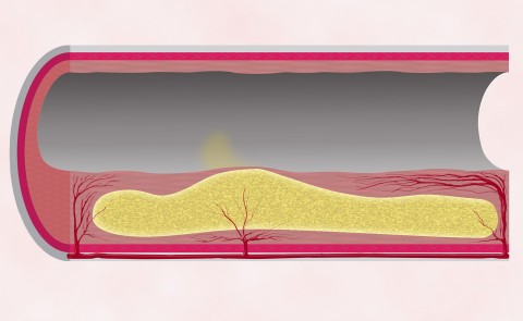 The illustration shows an arterial plaque. The yellow area is the lipid core. Blood vessels are unable to reach the center area,