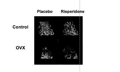 Image showing that risperidone causes bone loss even after ovariectomy (OVX).